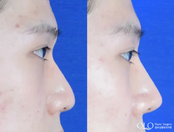 Before/After