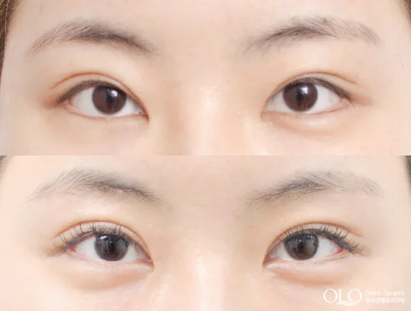 Before/After