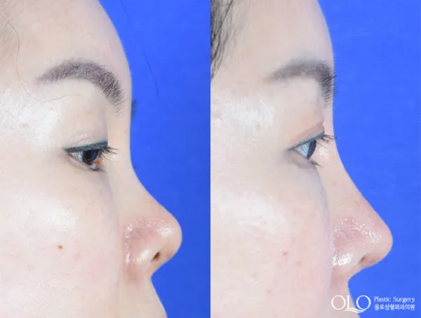 Before/After