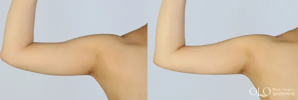 Before/After