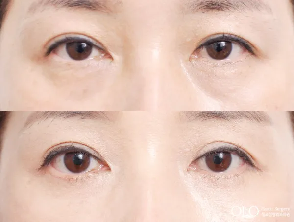 Before/After