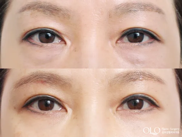 Before/After