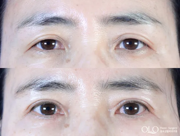 Before/After