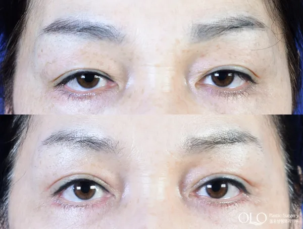 Before/After