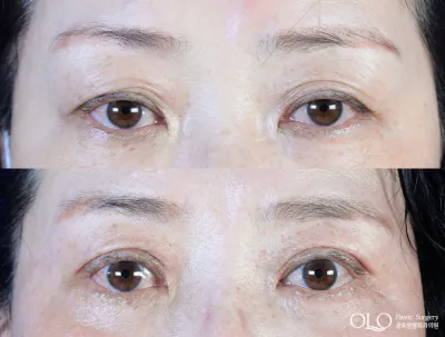 Before & After