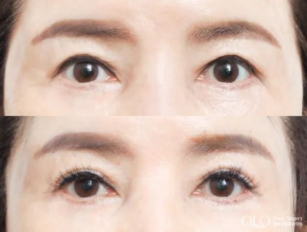 Before/After
