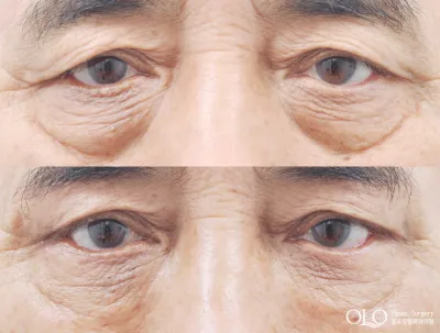 Before & After