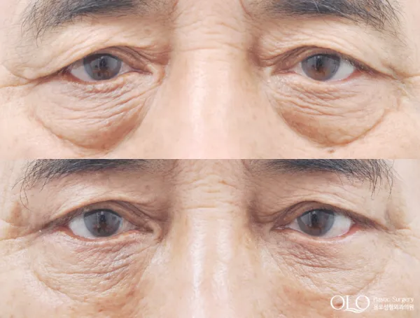 Before/After