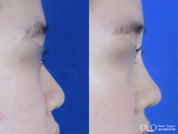 Before/After