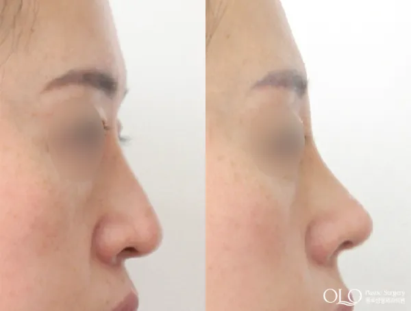 Before/After