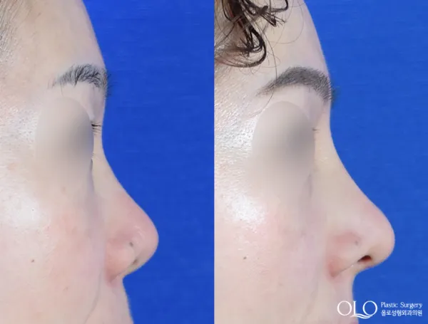 Before/After