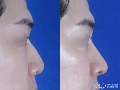 Before & After