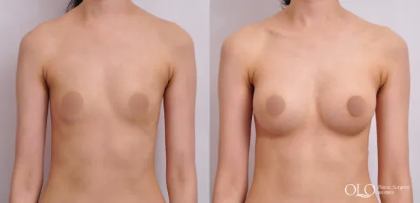 Before/After