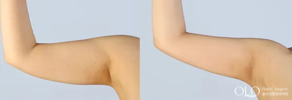 Before/After