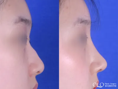 Before & After