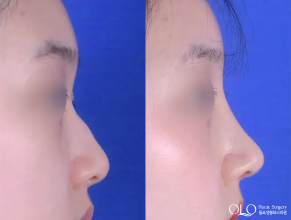 Before/After