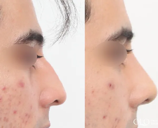Before/After