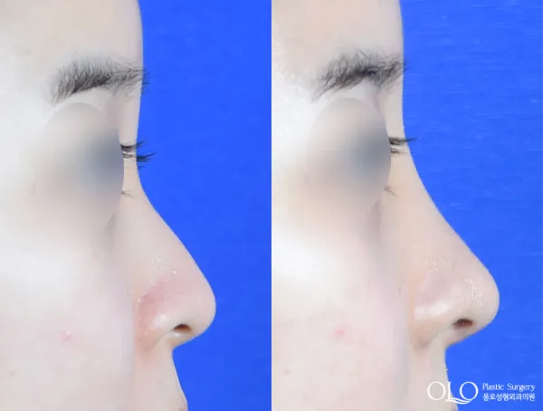 Before/After
