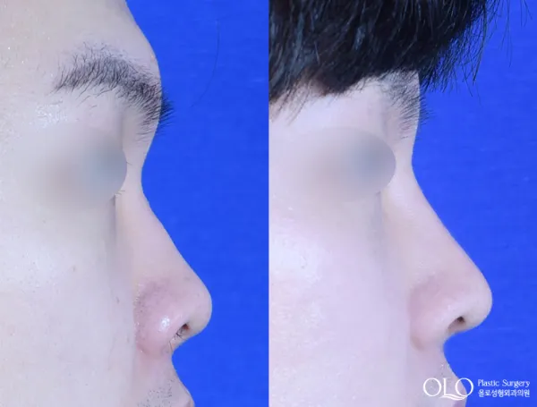 Before/After