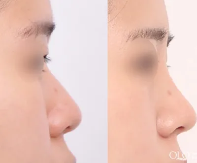Before & After