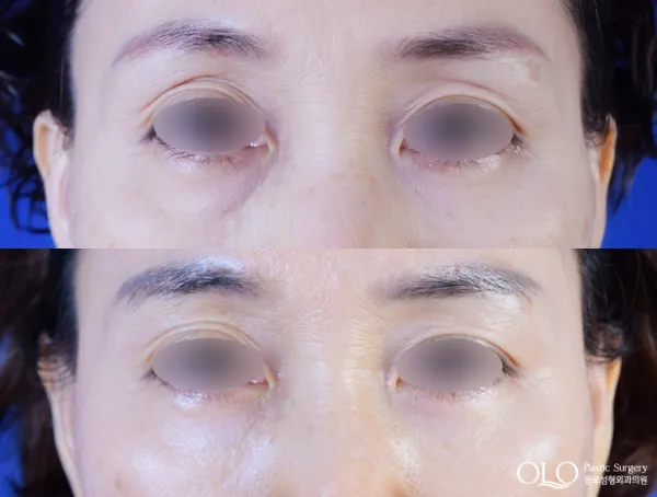 Before/After