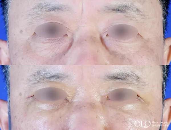 Before/After