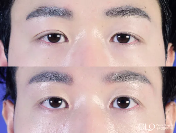 Before/After