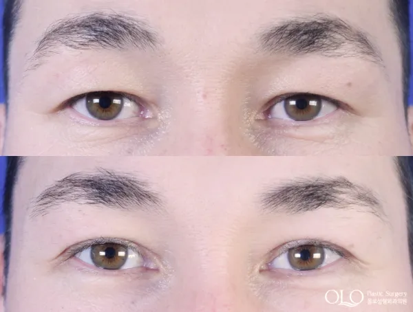 Before/After