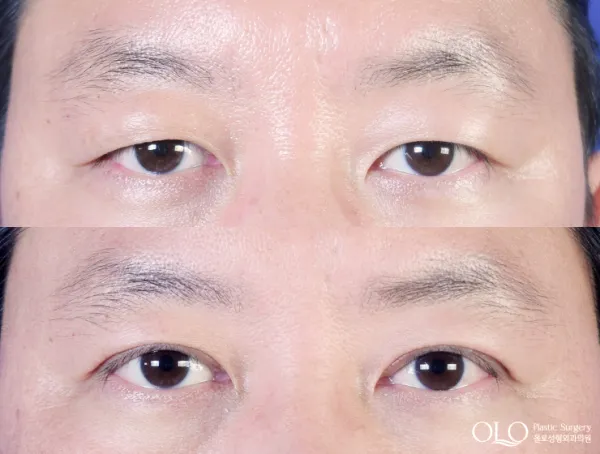 Before/After