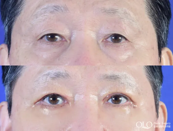 Before/After