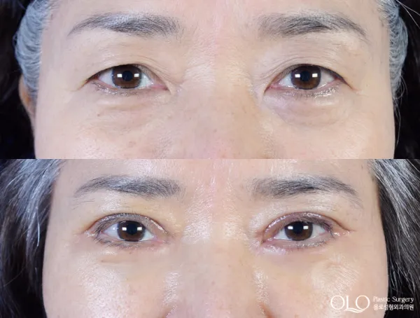 Before/After