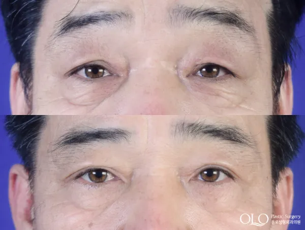 Before/After