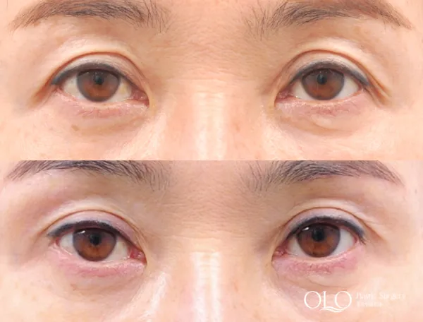 Before/After