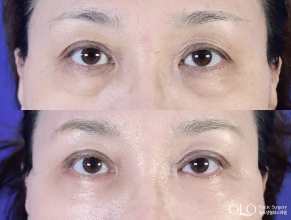Before/After