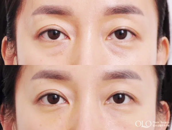 Before/After