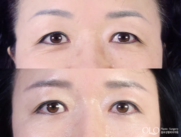 Before/After