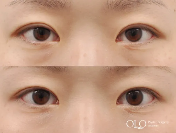 Before