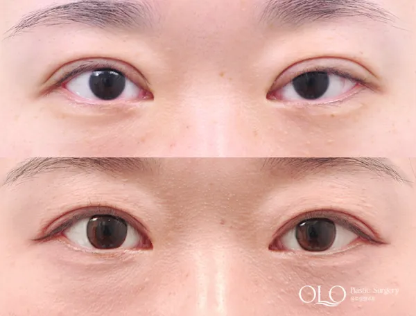 Before