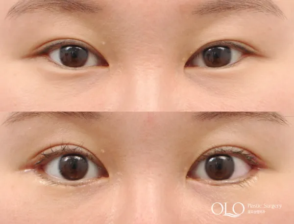 Before/After