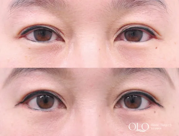 Before/After