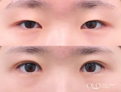 Before & After