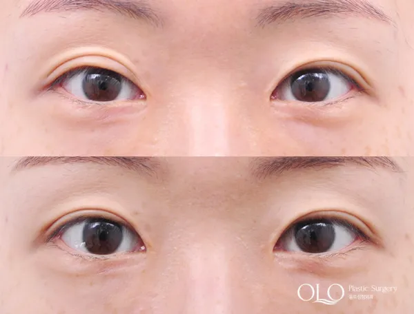 Before/After