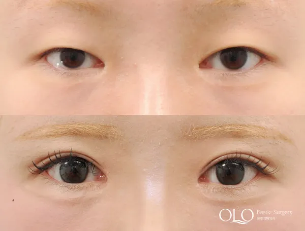 Before/After