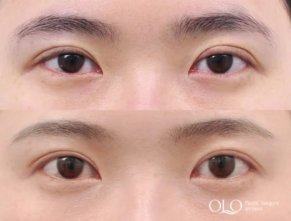 Before/After