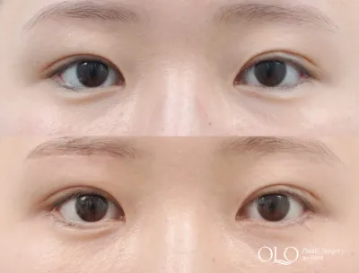 Before & After