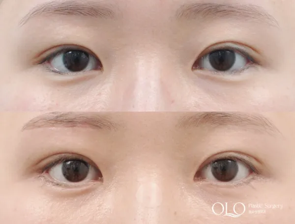Before/After