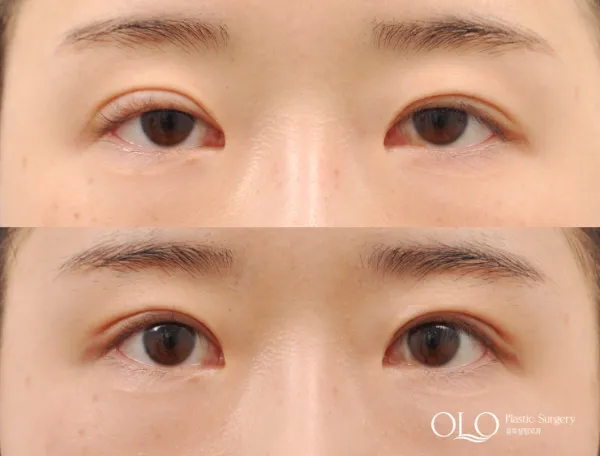 Before/After