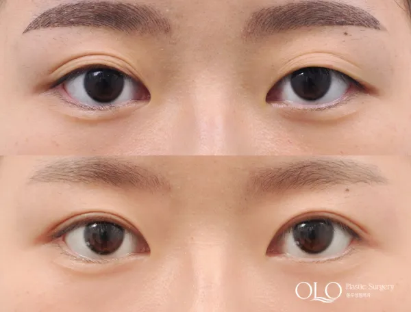 Before/After
