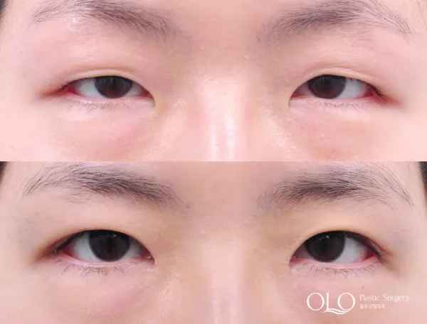 Before/After