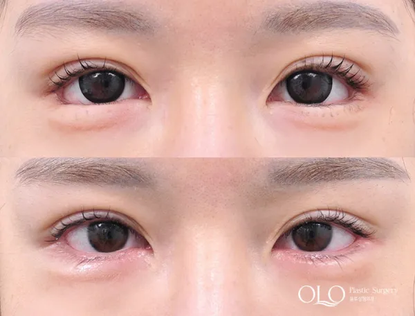 Before/After